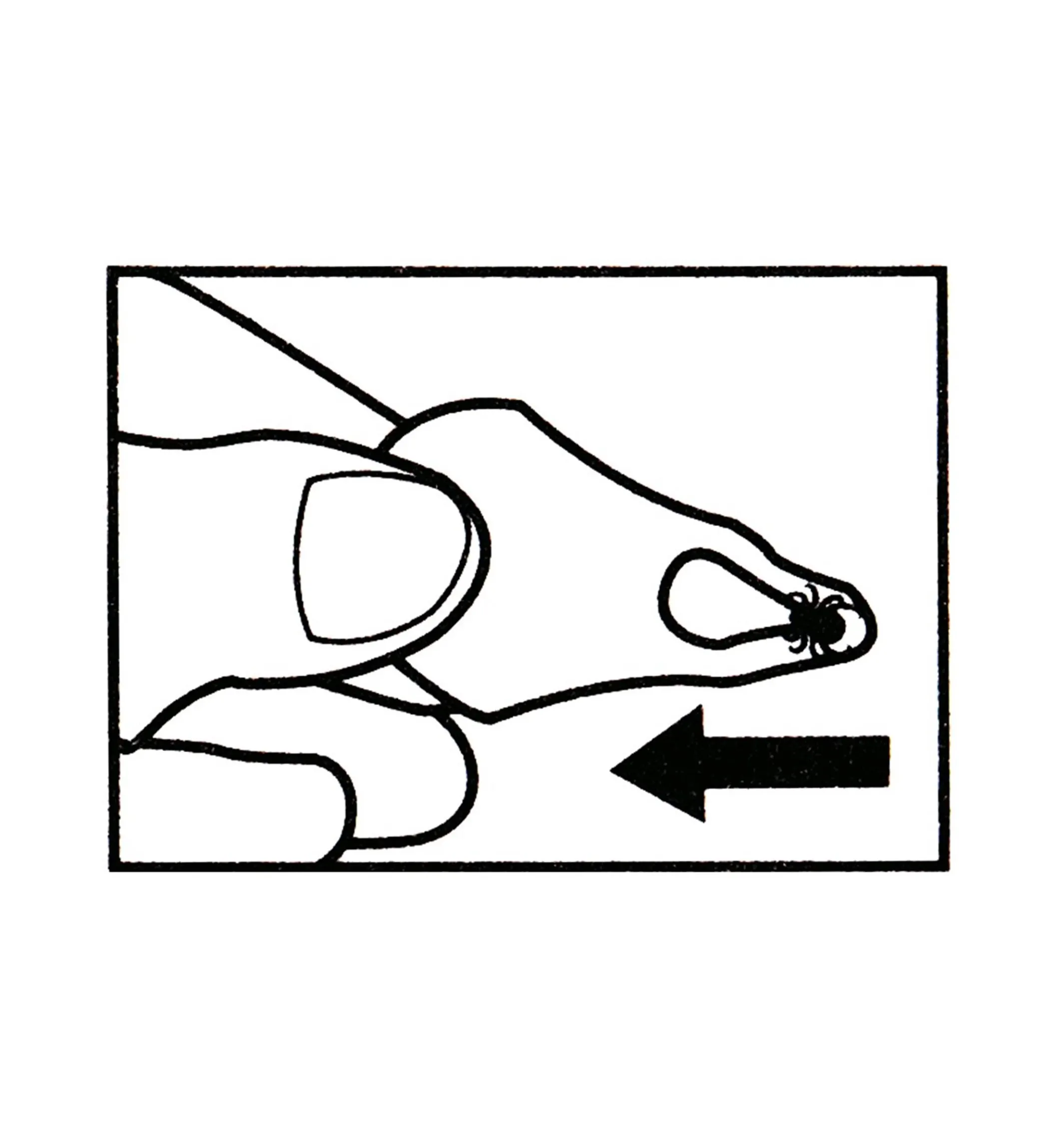 Tick Key Tick Remover