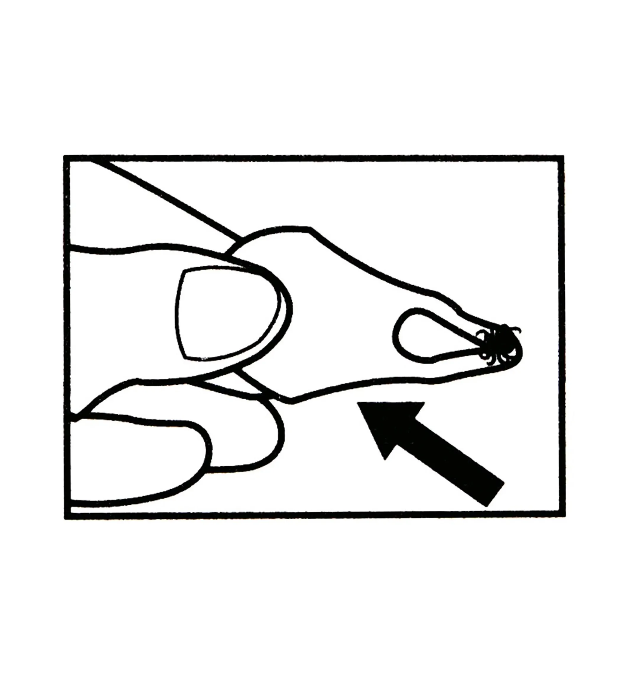 Tick Key Tick Remover